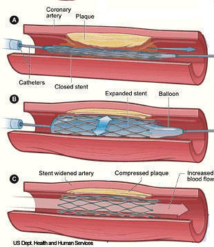 angioplasty stent