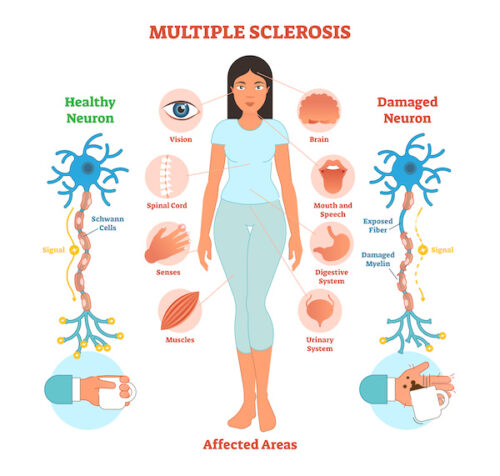 Multiple Sclerosis (MS) & Diet