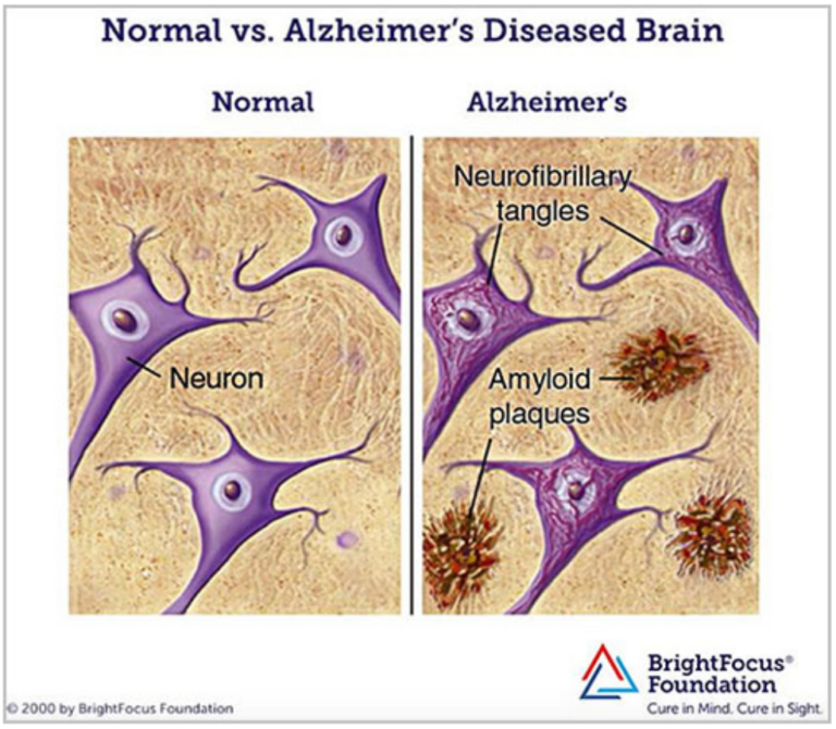 Alzheimer's Disease is Caused by Chronic Aluminum Poisoning Dr. McDougall