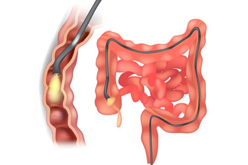 McDougall's Medicine: Colonoscopy - A Test to Refuse