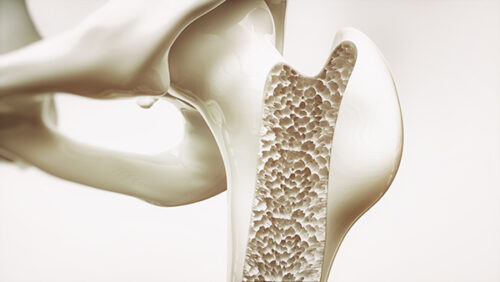 Resisting the Broken Bone Businesses: Bone Mineral Density Tests and the Drugs That Follow