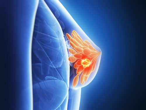 John McDougall, MD: The Facts About Breast Cancer