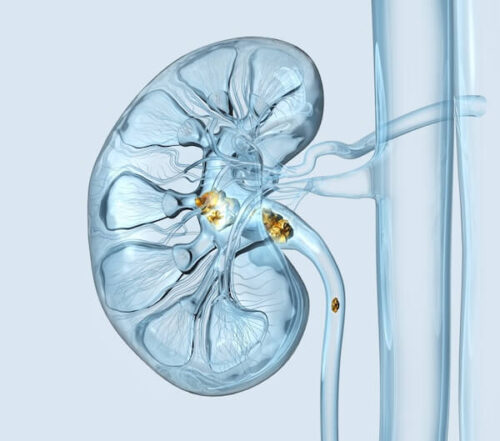 The Truth About Oxalates & Kidney Stones